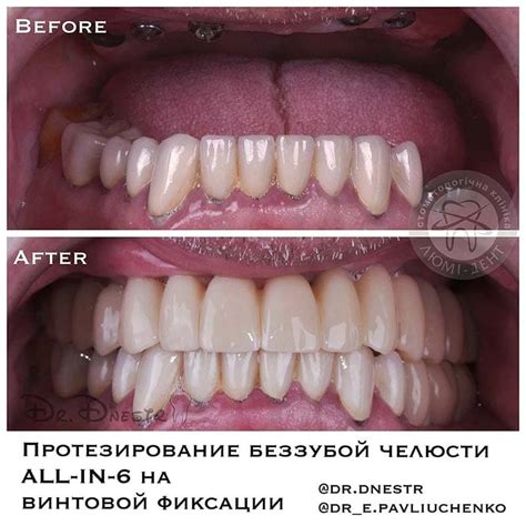 Имплантация Зубов Киев Цена На Импланты ЛюмиДент