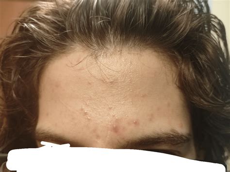 Nothing works for my forehead acne : r/acne