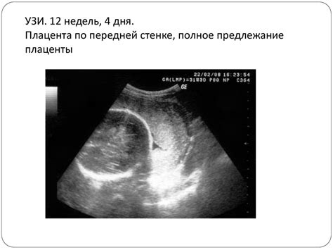 Предлежание плаценты. Понятие, классификация, этиология и патогенез ...