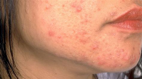 Pustular Psoriasis Face