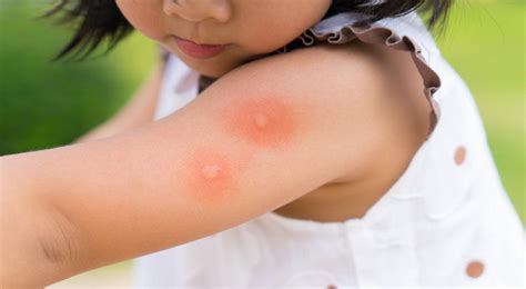 Alergia A Picada De Inseto Em Bebe - Como tratar picadas de insetos em bebês e crianças? - Comunidade Alô Bebê