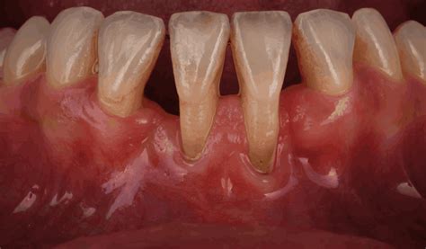¿Cómo parar la periodontitis? - Nart Clínica Dental