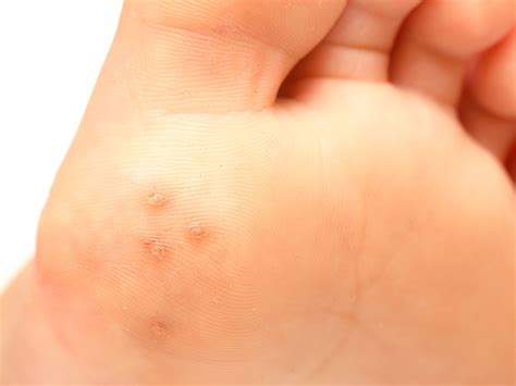 How To Keep Warts From Coming Back - Theatrecouple12