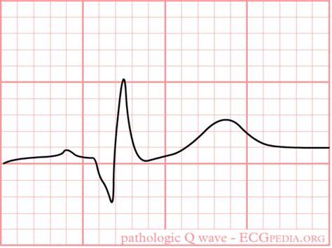 Pathologic Q Waves - ECGpedia