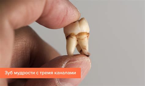 Что такое зуб мудрости