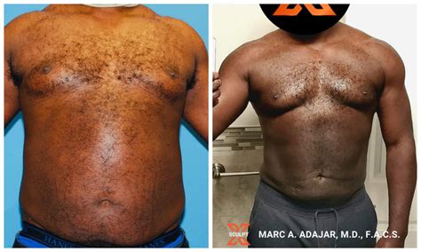 Gynecomastia Before And After Weight Loss