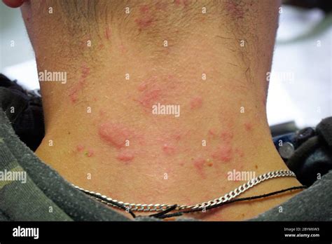 Itchy Rash On Neck Allergic Reaction at Kecia Martin blog