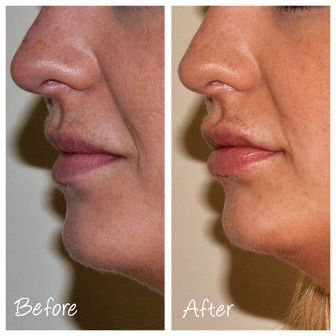 A-Z of Dermal Fillers - Cosmetic Courses