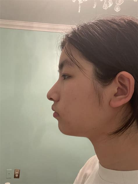 Do I have a recessed jaw? If so, what can I do to fix it? : r/jawsurgery