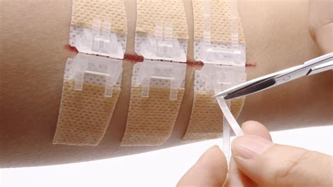wound closure device fannin