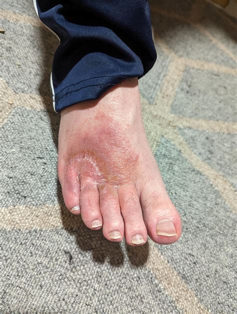 Skin infection on foot unknown diagnosis : r/MedicalGore