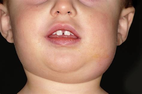 Mumps Photograph by Dr P. Marazzi/science Photo Library
