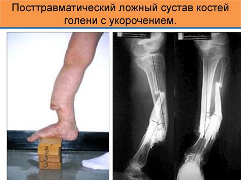 Принципы и современные методы лечения переломов. Несросшиеся переломы ...