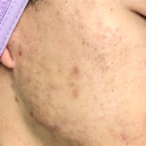 Platelet-Rich Plasma (PRP) | Pure Touch Aesthetic & Cosmetic Surgery Clinic