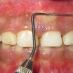 Mucogingival junction - Definition of Mucogingival junction