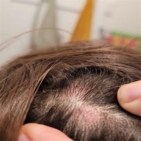 Itchy scalp rash/lesions : r/Dermatology