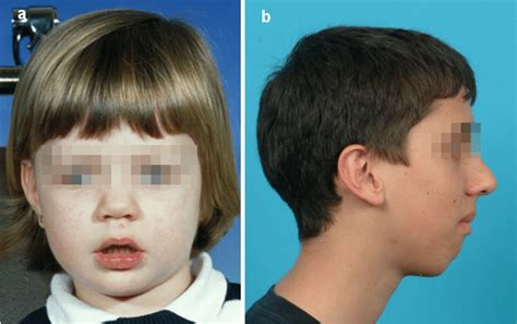 Enlarged Adenoids Adenoid Facies Youtube - vrogue.co