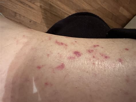Sarcoidosis Rash