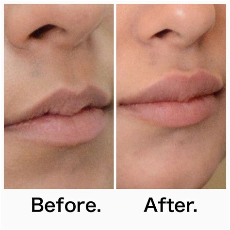 Needle Free Lip Filler Cost | octoberrobertbywest