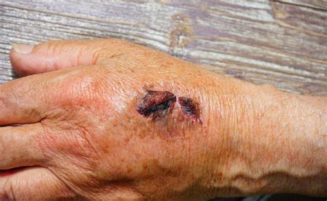 Scabs – Dream Meaning and Interpretation | Dream Glossary
