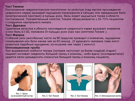 Нейропатия срединного нерва - презентация онлайн