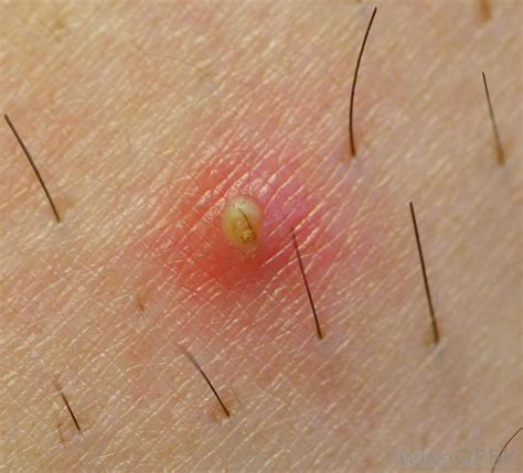 Infected Ingrown Hair: Symptoms and Treatments | New Health Advisor