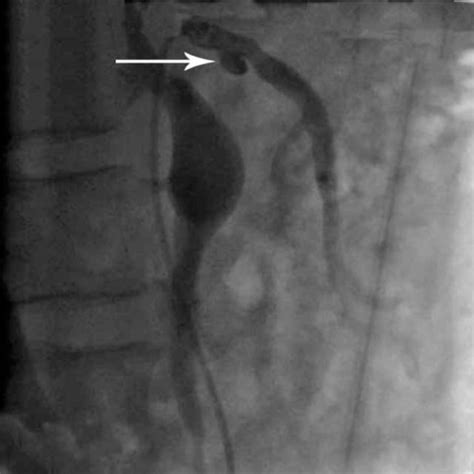 (PDF) Isolated Dissection of Superior Mesenteric Artery