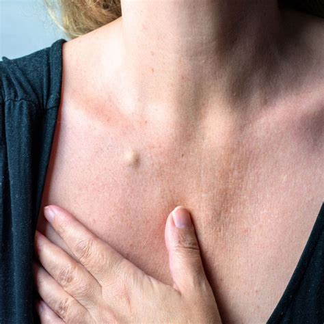 rimozione  cisti sebacee bergamo poliambulatorio finazzi