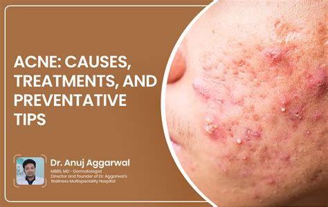 Body Acne: Causes, Treatments, and Prevention Tips - Hunter Games Magazine