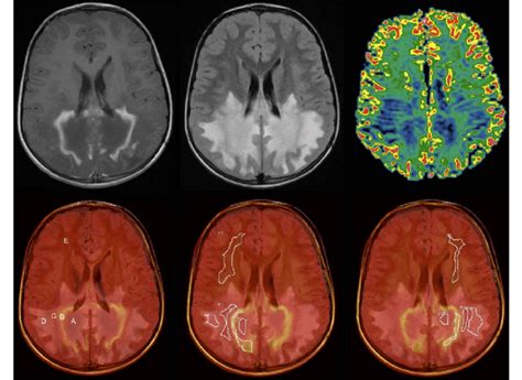 Figure. Nine-year-old male patient with symptomatic ALD. Post-contrast ...