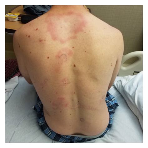 Photograph demonstrating the patient’s diffuse rash with multiple ...