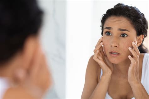 10 Best Dermatitis Creams For Your Face | Best Dermatitis Cream