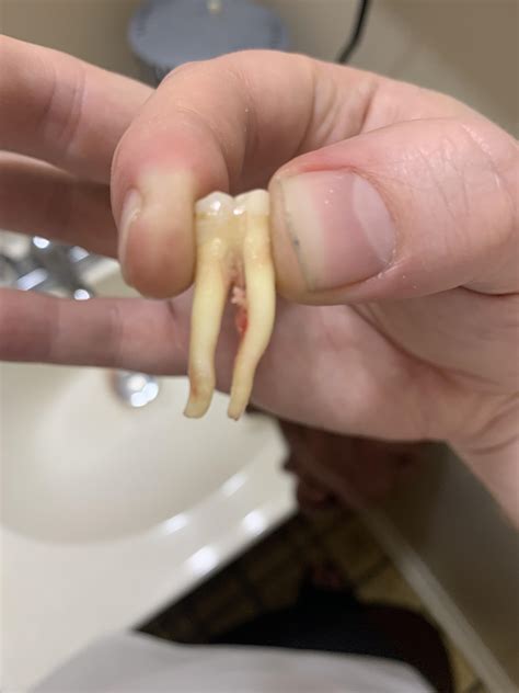 Wisdom Teeth Roots