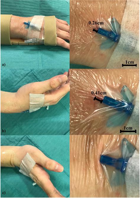 Simple Tips About How To Prevent Phlebitis - Securityquarter28