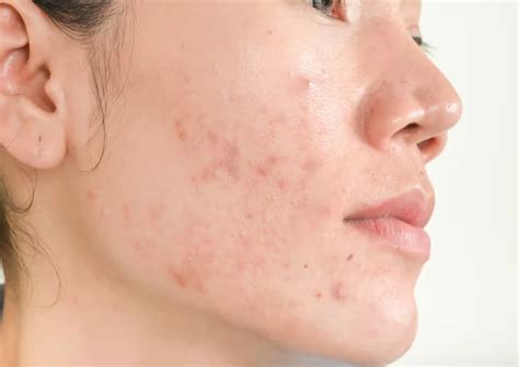 fungal acne simak ciri penyebab   mengobatinya