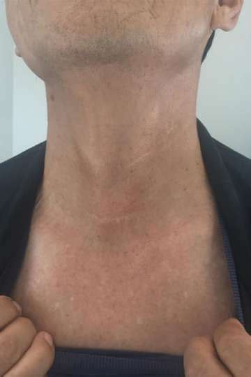 Scar Photos - Thyroid Cancer Surgery, Thyroidectomy - Endocrine Surgery ...