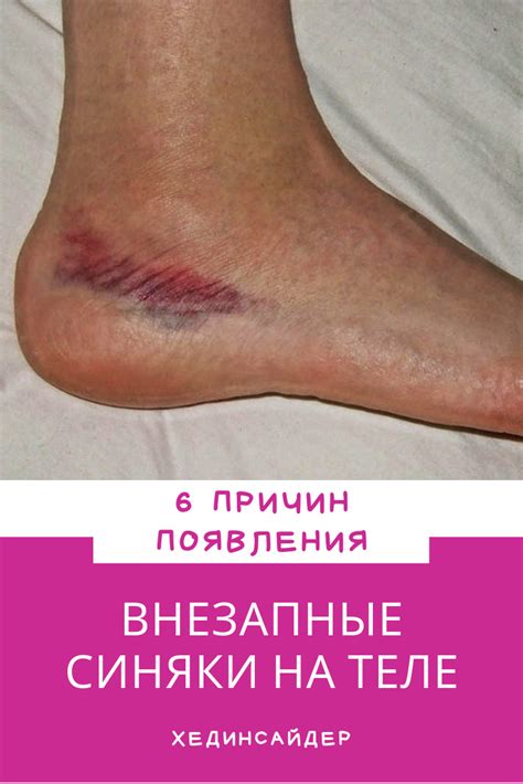 6 причин появления внезапных синяков на теле - HeadInsider | Здоровье ...
