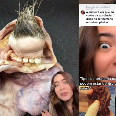 Cisto No Ovario Com Cabelo E Dente - Cisto Ovariano Com Cabelo E Dentes