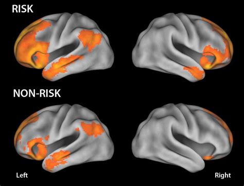 Autism brain scan picture free image download
