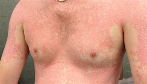 Scaly erythematous rash - Clinical Advisor