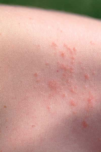 Heat rash or prickly heat | Raising Children Network