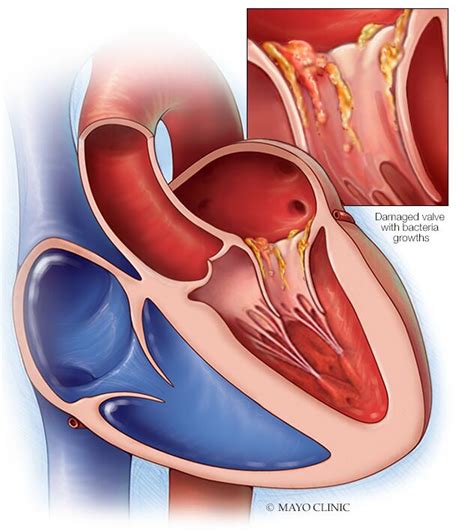 Endocarditis - Symptoms & causes - Mayo Clinic