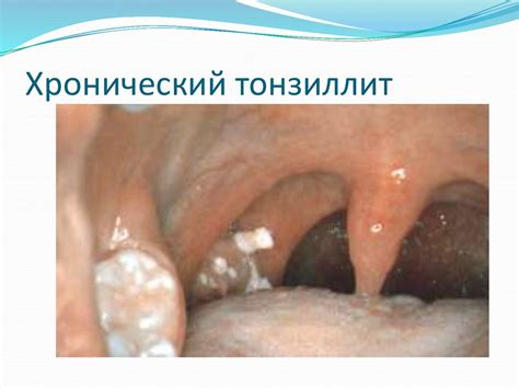 Хронический тонзиллит - презентация онлайн