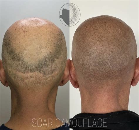 Best Scalp Micropigmentation Mosman, Parramatta, Bankstown