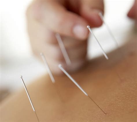 Acupuncture what you need to know – Artofit
