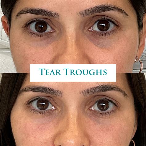 tear trough masterclass dr ravi jain