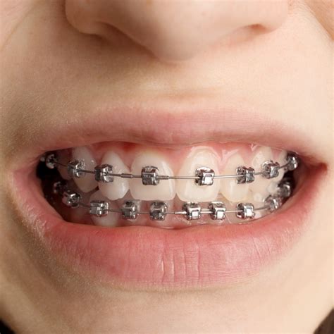 jenis jenis behel  perlu kamu ketahui sociamedic