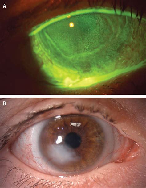 neurotrophic keratitis resolution   neurotrophic keratopathy
