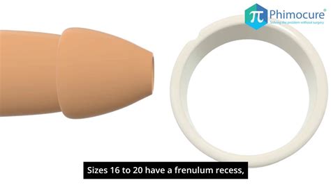 Tight Foreskin Stretching with Phimosis Rings - YouTube
