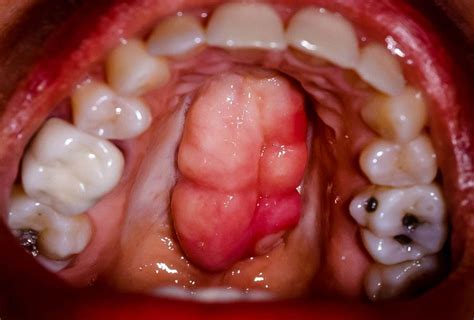 Extracciondeltorusmandibularis